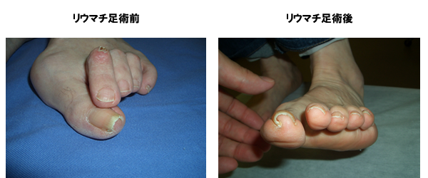 指 足 症状 の 骨折 足の指を疲労骨折した時の症状は？